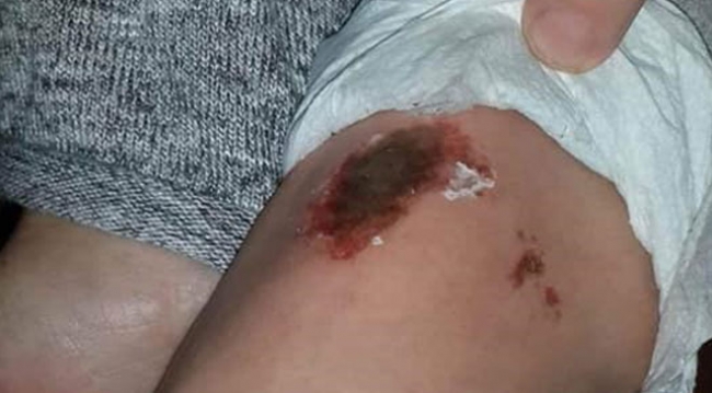 Karla oynayan öğrencilerin vücutlarında lekeler oluştu