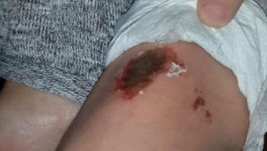 Karla oynayan öğrencilerin vücutlarında lekeler oluştu