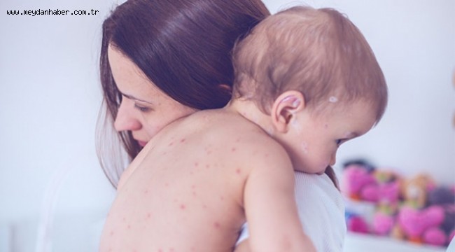 Kızamık 2 bin 500 yıl önce büyükbaş hayvanlardan geçmiş olabilir