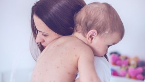 Kızamık 2 bin 500 yıl önce büyükbaş hayvanlardan geçmiş olabilir