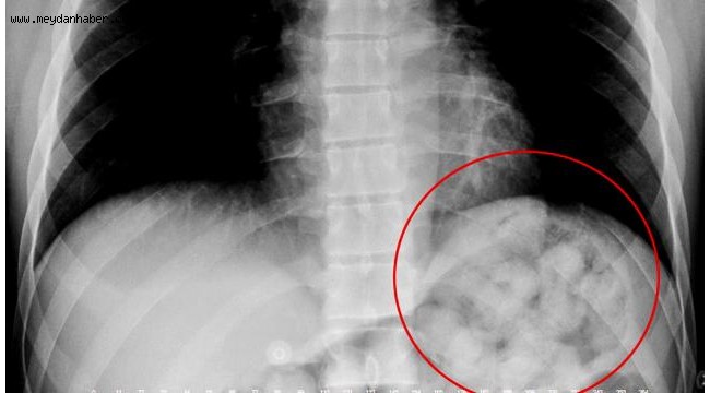 Midesinden 900 gram uyuşturucu madde çıktı