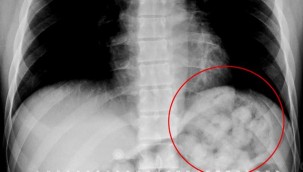 Midesinden 900 gram uyuşturucu madde çıktı