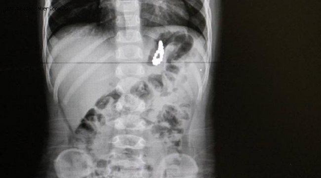 Bir çocuğun midesinden 17 mıknatıs çıkarıldı