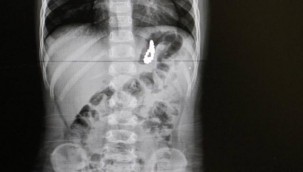 Bir çocuğun midesinden 17 mıknatıs çıkarıldı